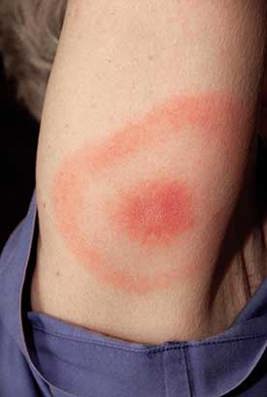 Bullseye rash
